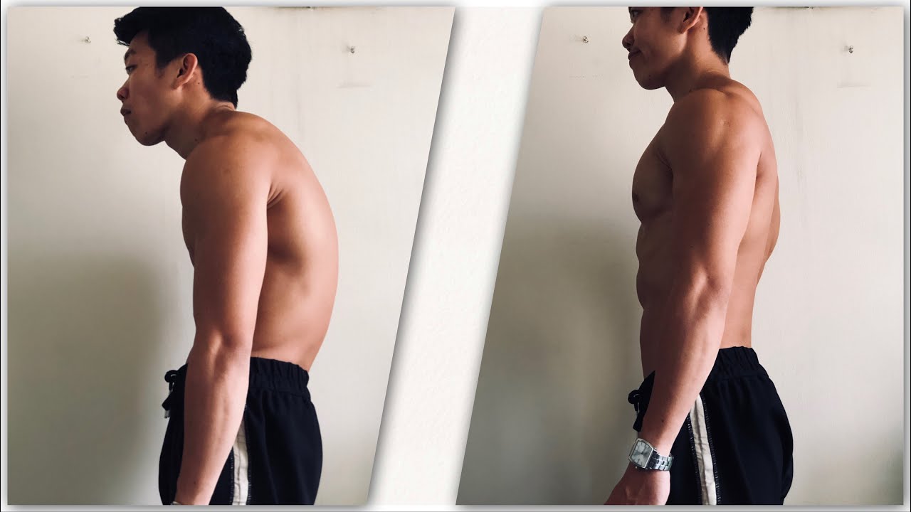 Cách trị gù lưng đơn giản nhưng hiệu quả