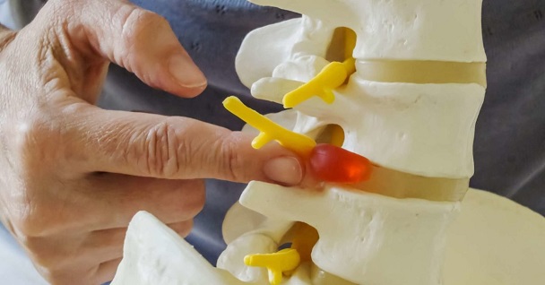 Các biến chứng nguy hiểm của thoát vị đĩa đệm L4-L5